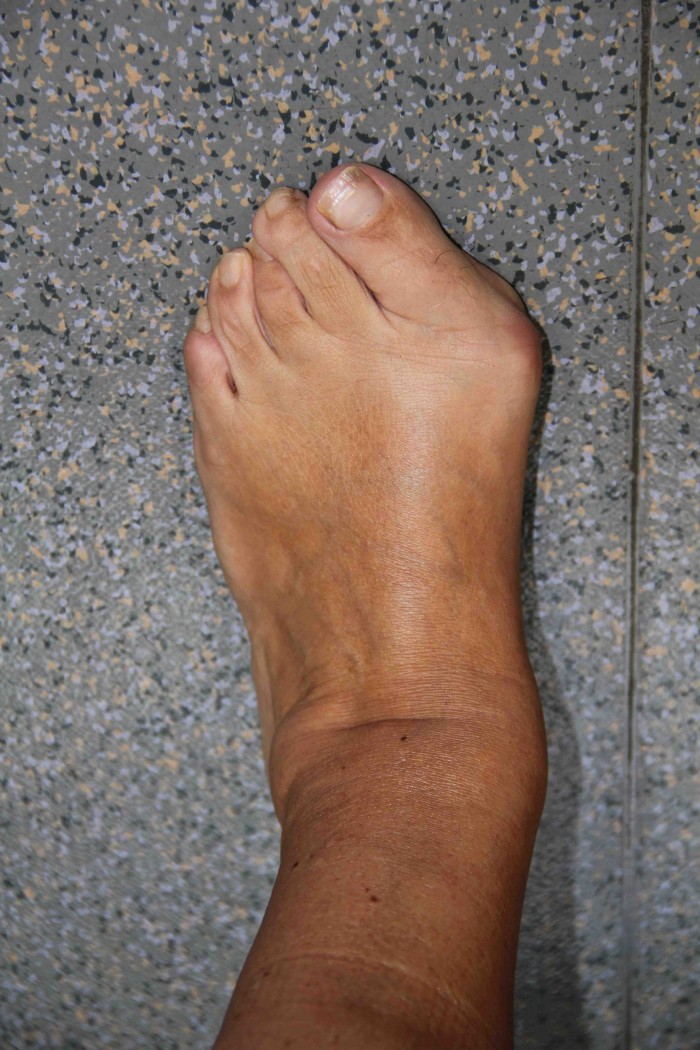 Hallux Valgus | PCNA : Pied Cheville Nantes Atlantique